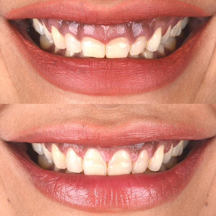 חיוך חושף חניכיים חיוך חושף חניכיים