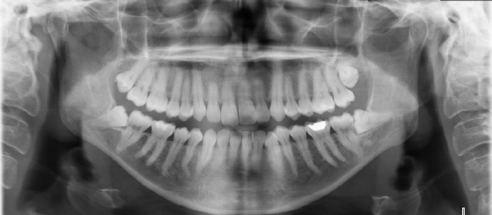 עקירה כירורגית של שן בינה כלואה