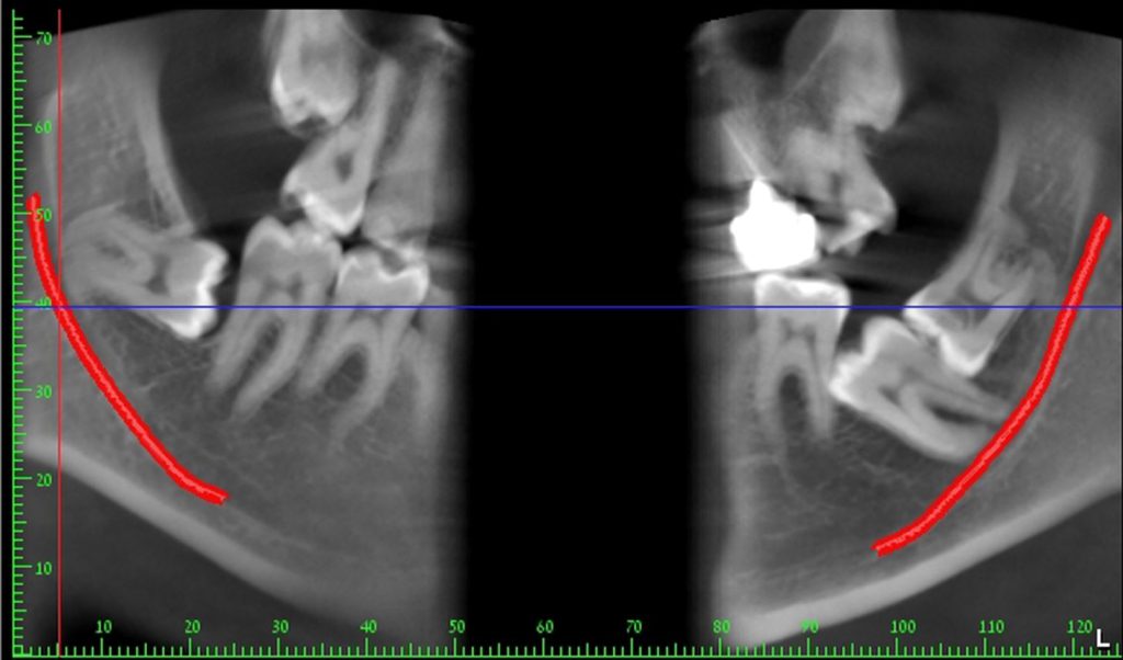 צילום רנטגן של שן בינה כלואה