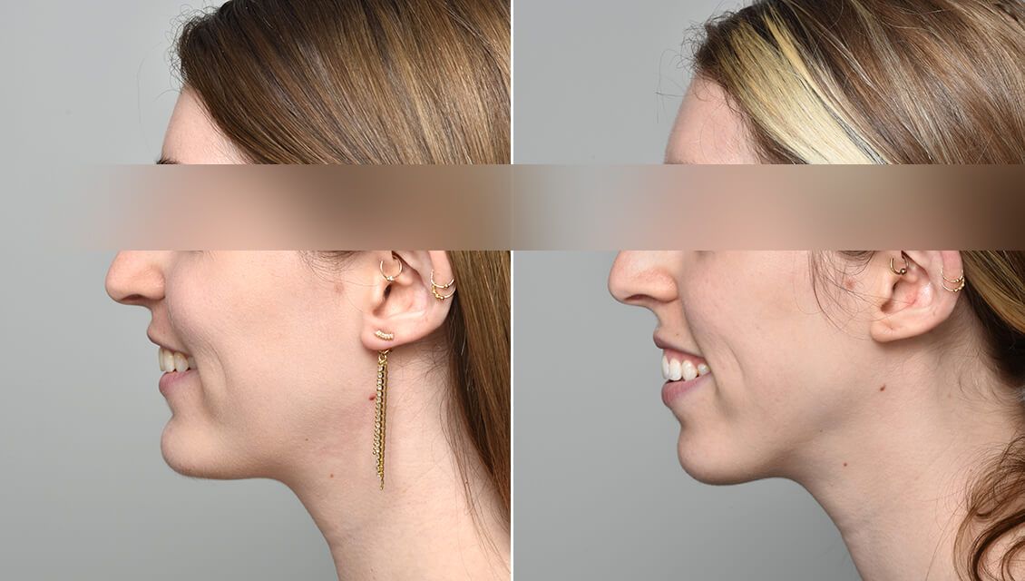 ניתוח אורתוגנטי לפני ואחרי