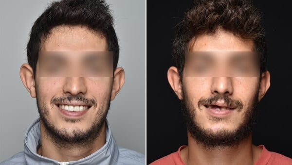 מומחים לכירורגיית פה ולסת בהובלת ד״ר שוורץ-ארד פרוחי-רן-לפני-אחרי