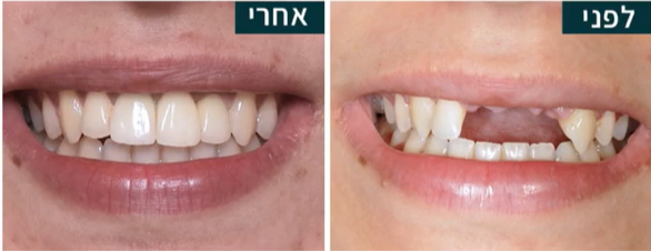 למה חשוב לטפל מיידית בחבלות בשיניים?